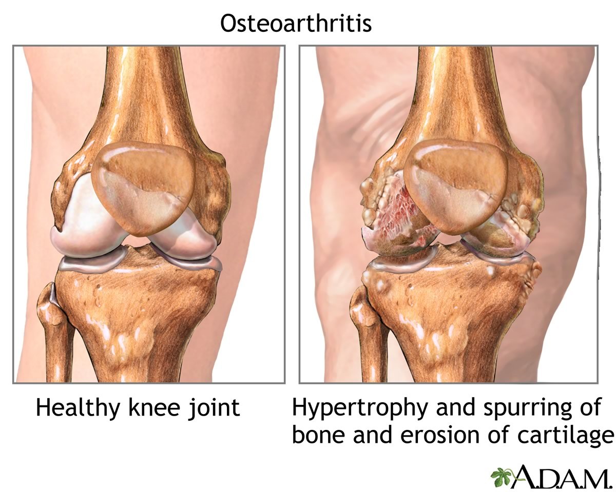 Medical drawing depicting a healthy knee joint vs a knee joint afflicted with osteoarthritis.