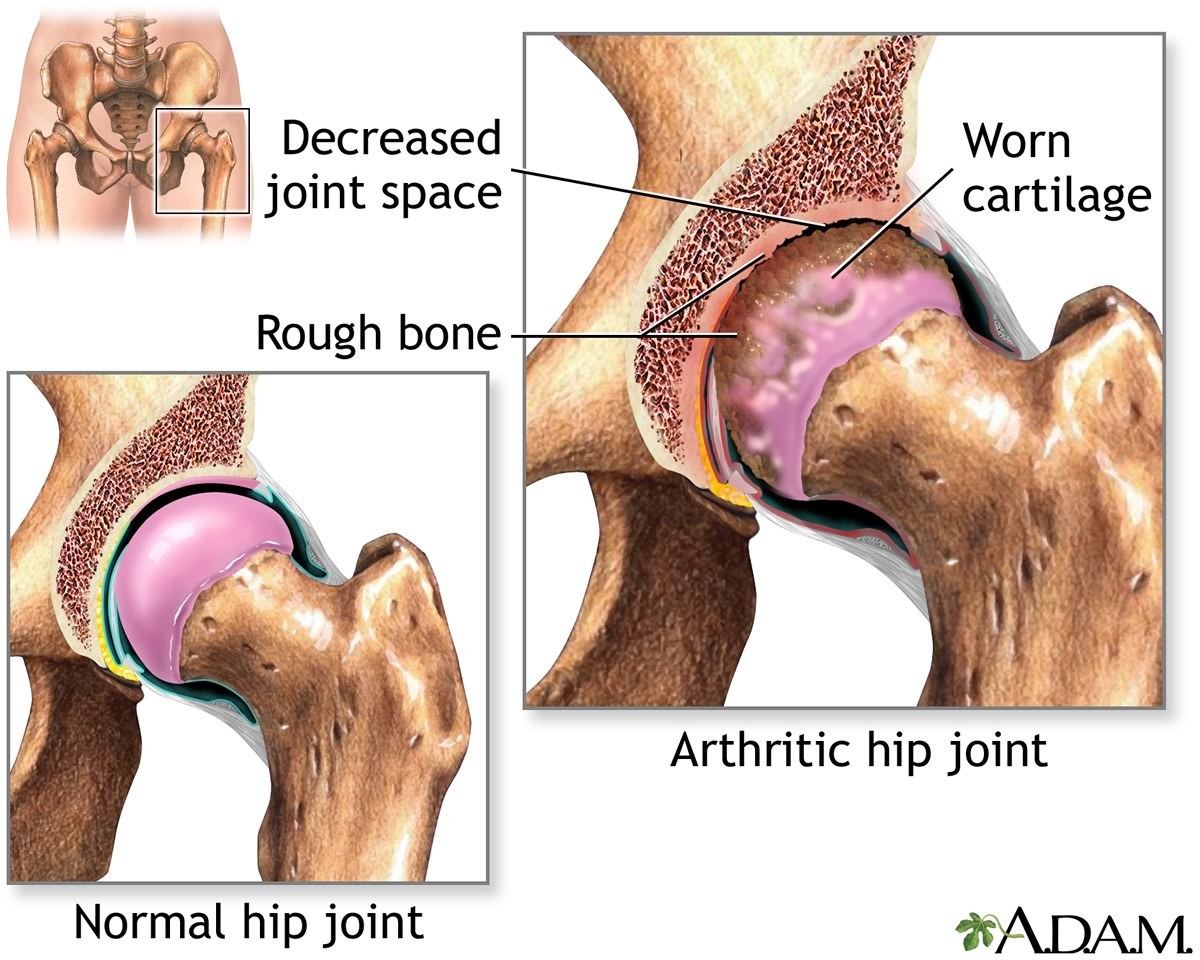 Medical drawing depicting the normal hip joint vs an arthritic hip joint. The arthritic hip joint is rough and has ragged edges where the normal joint is smooth.